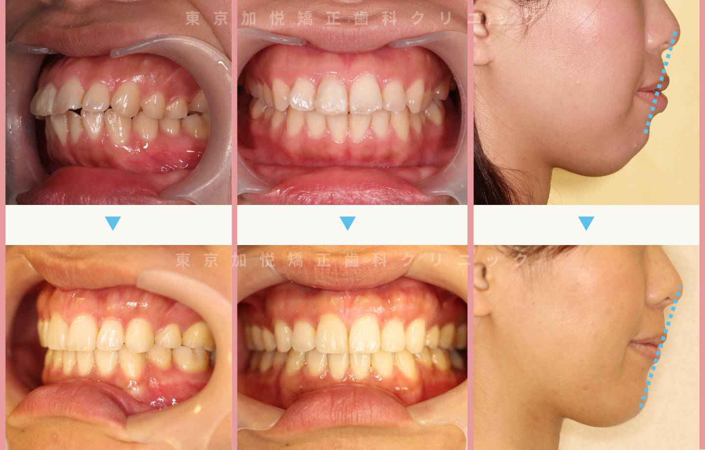 出っ歯矯正症例１-全顎矯正（抜歯あり）で出っ歯を治療した26才女性