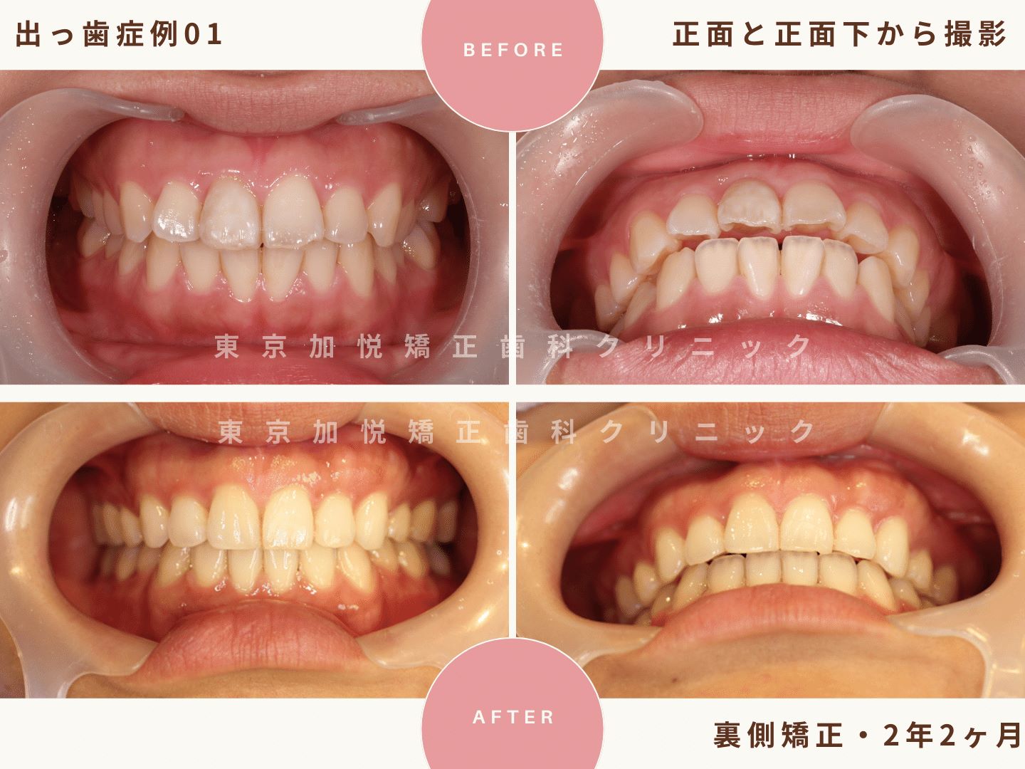 出っ歯矯正症例１、正面と正面下からの撮影BeforeAfter