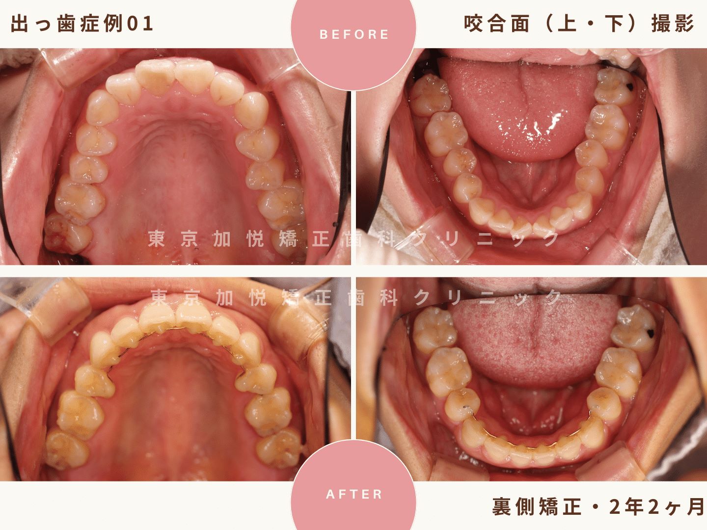 出っ歯矯正症例１、咬合面（上下）からの撮影BeforeAfter
