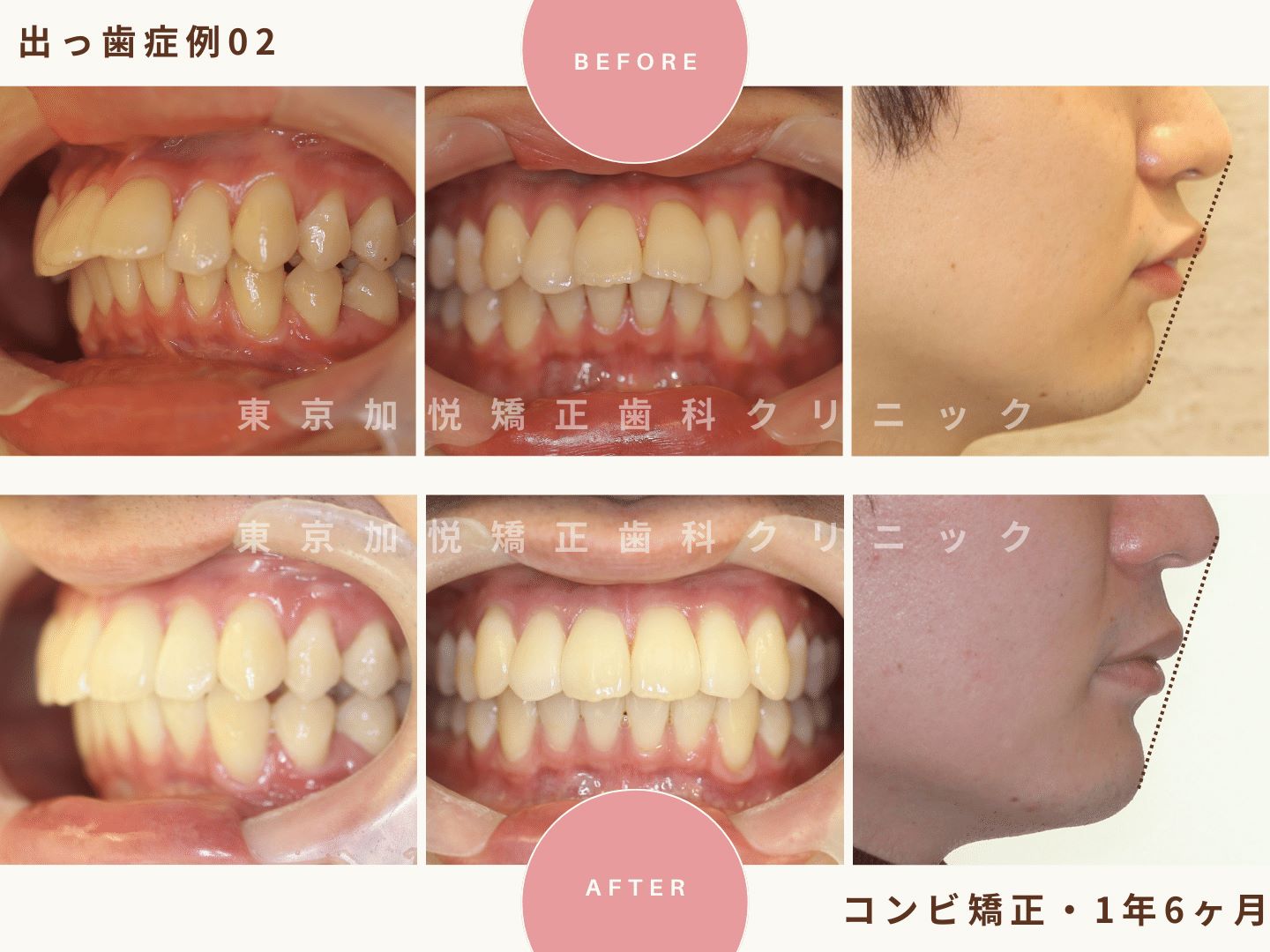 出っ歯症例2、全顎矯正（抜歯なし）で出っ歯を治療した20代　男性