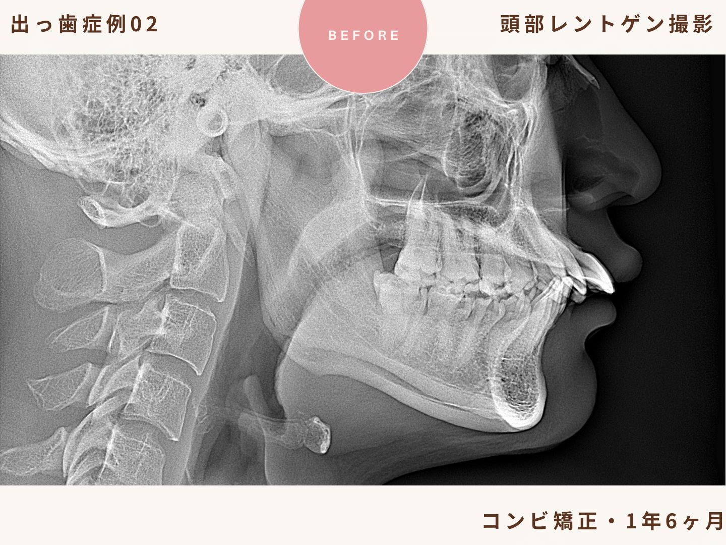 出っ歯矯正症例2、頭部レントゲン撮影