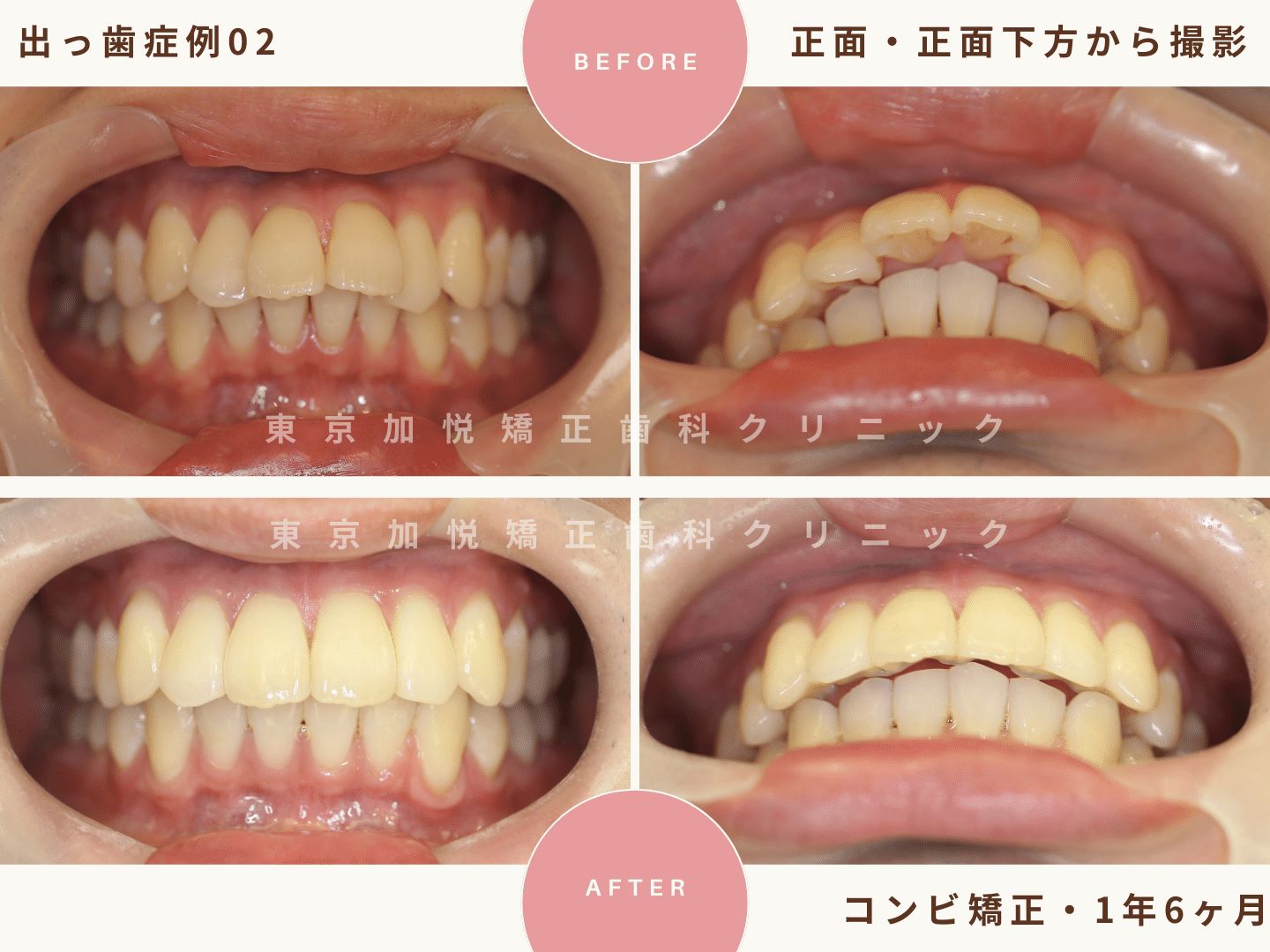 出っ歯矯正症例2、正面・正面下からの撮影BeforeAfter