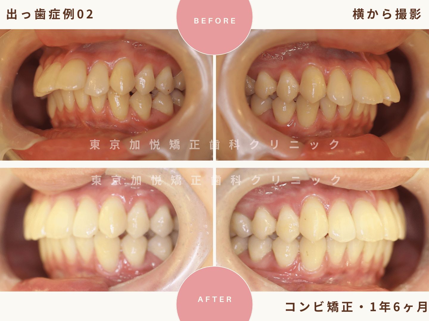 出っ歯矯正症例2、横から撮影BeforeAfter