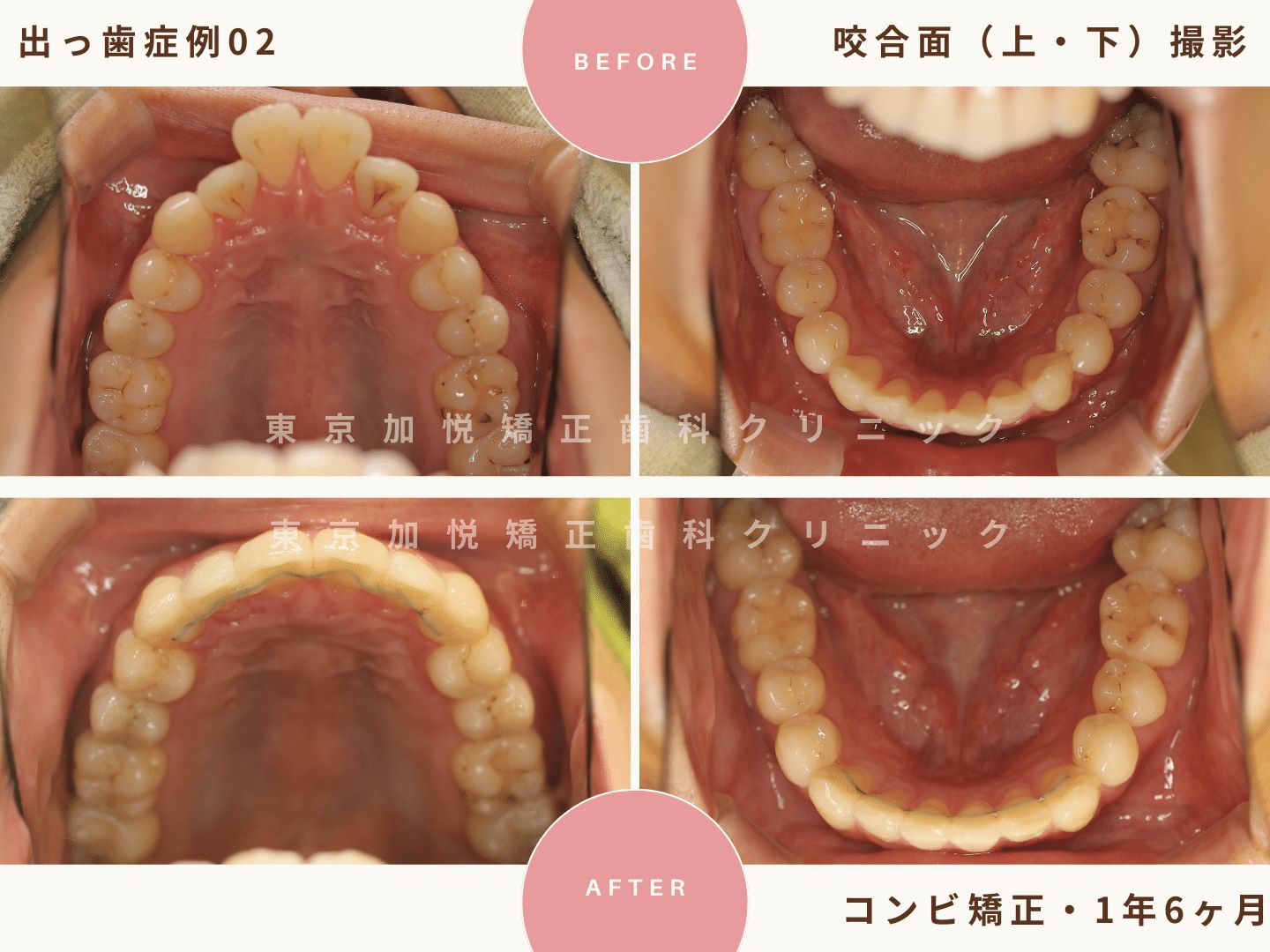 出っ歯矯正症例2、咬合面（上下）撮影BeforeAfter