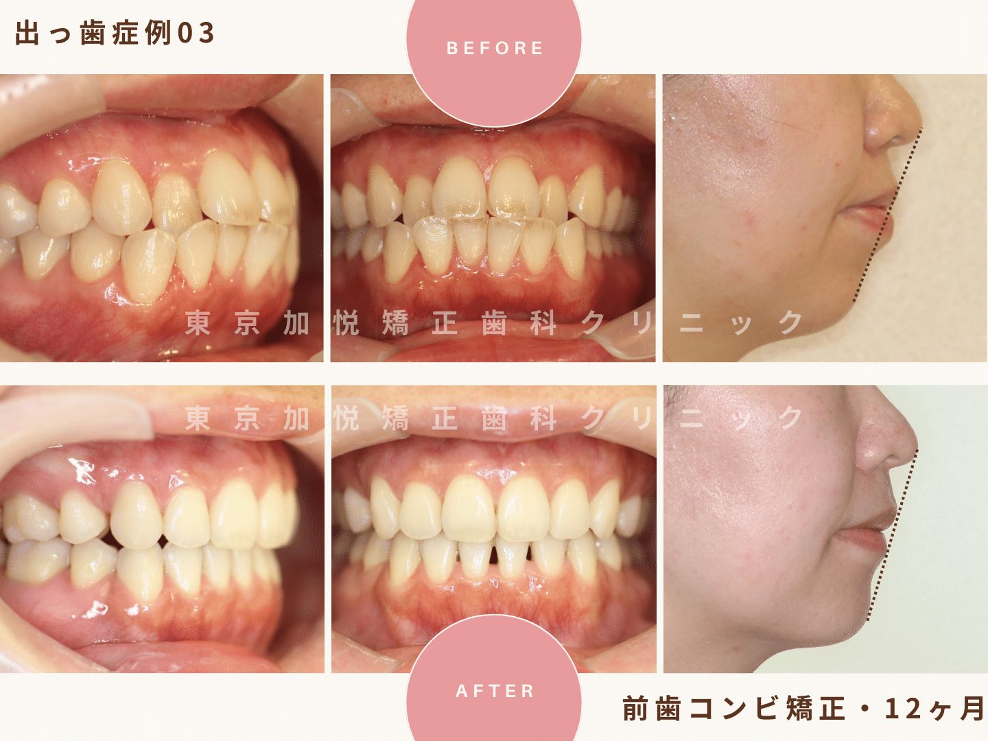 出っ歯矯正症例3、前歯だけの矯正（抜歯あり）で出っ歯を治療した30代女性