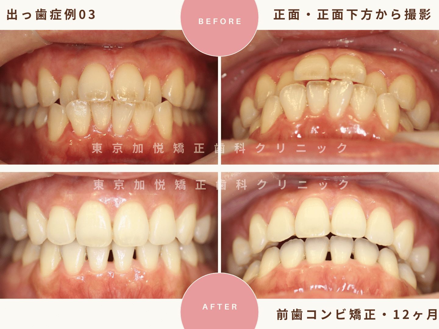 出っ歯矯正症例3、正面・正面下からの撮影BeforeAfter