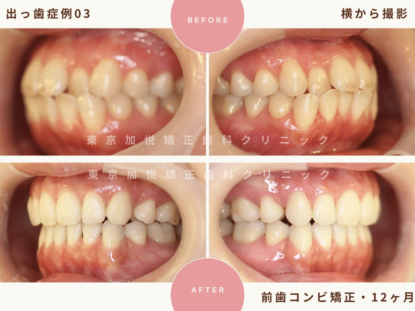 出っ歯矯正症例3、横から撮影BeforeAfter