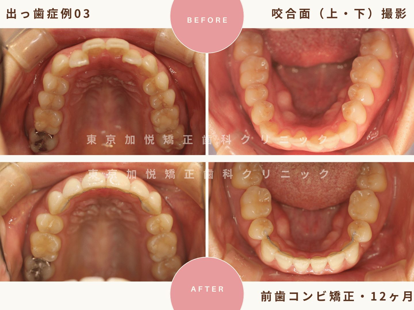 出っ歯矯正症例3、咬合面（上下）撮影BeforeAfter