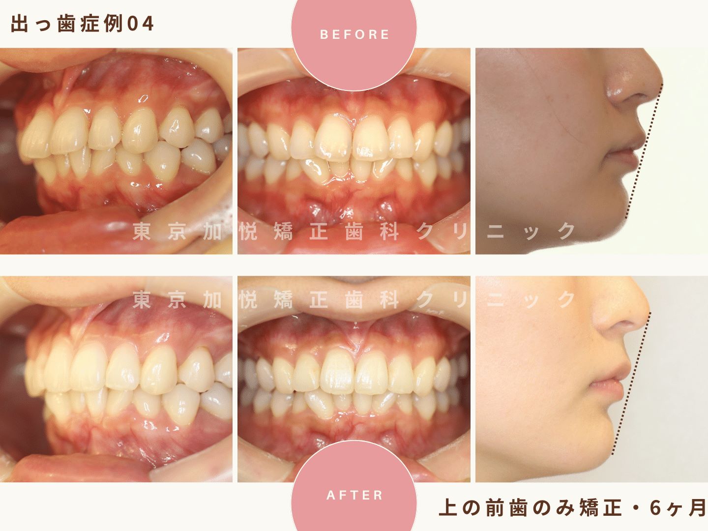 出っ歯矯正症例4、上の前歯だけの矯正で出っ歯を治療した23才女性