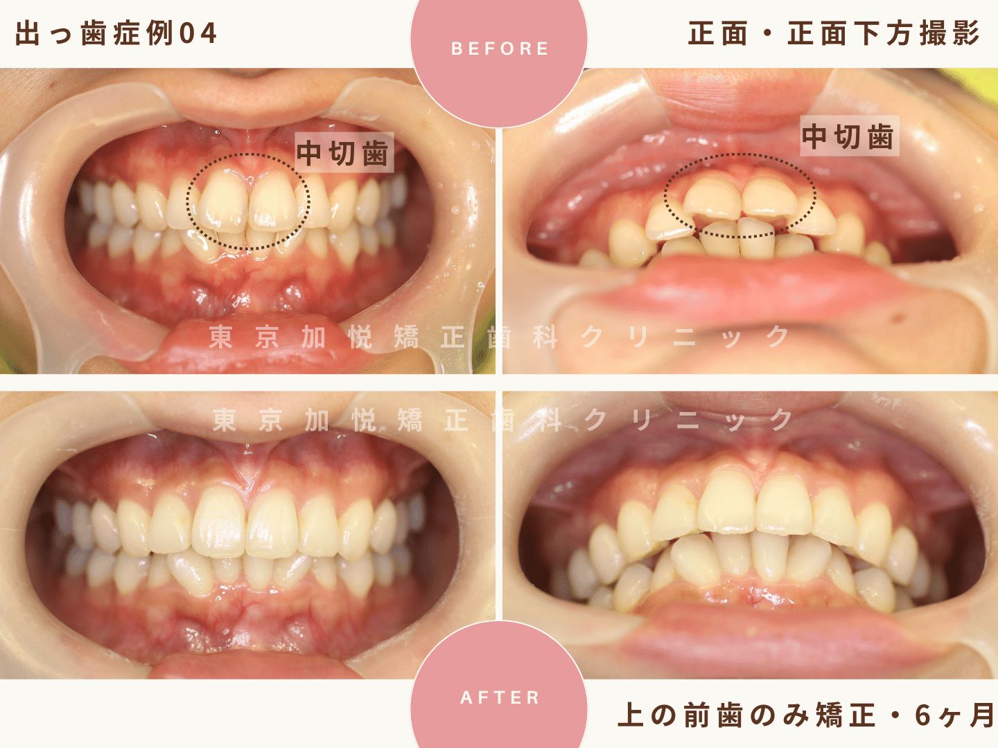 出っ歯矯正症例4、正面・正面下方向撮影BefoerAfter