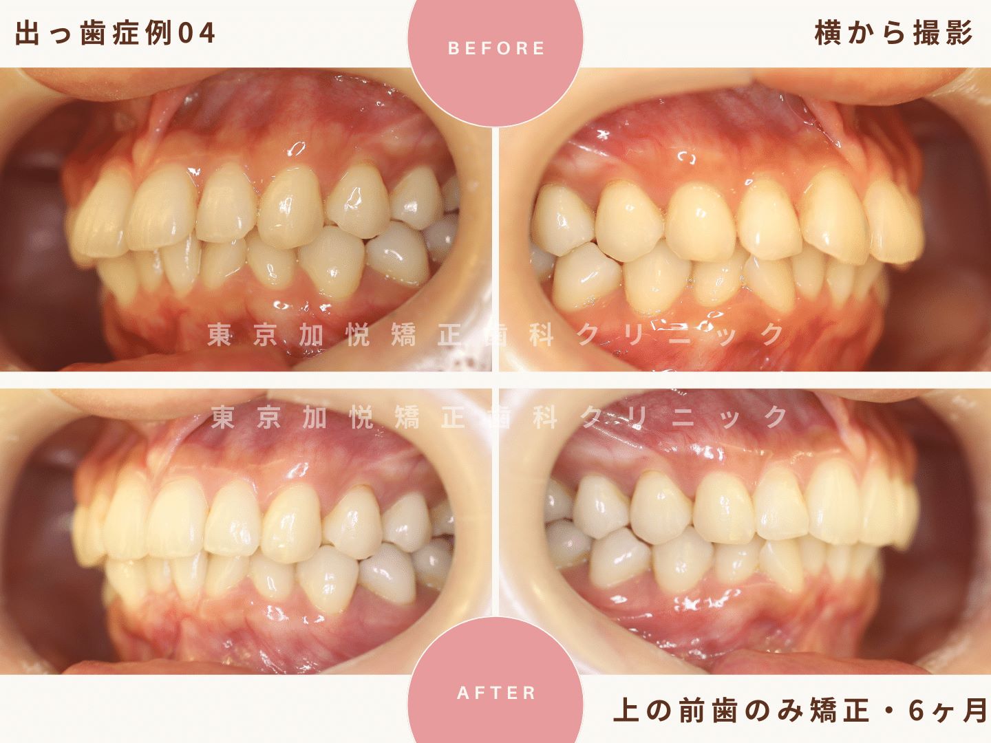 出っ歯矯正症例4、横から撮影BeforeAfter