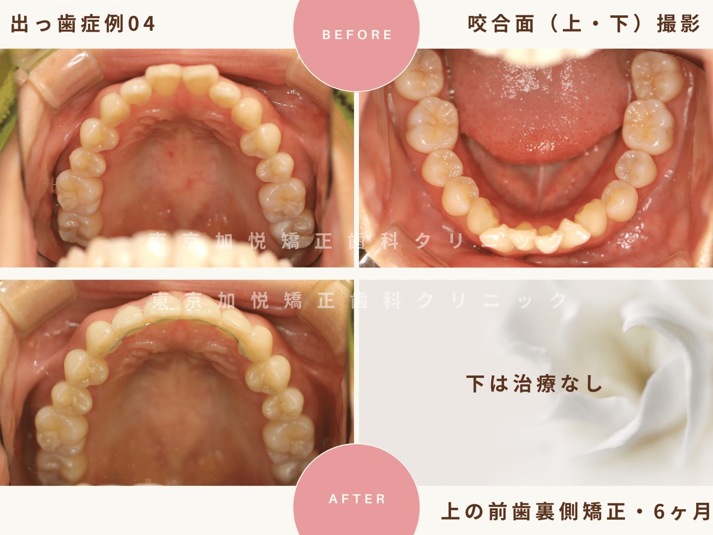 出っ歯矯正症例4、咬合面（上下）撮影BeforeAfter