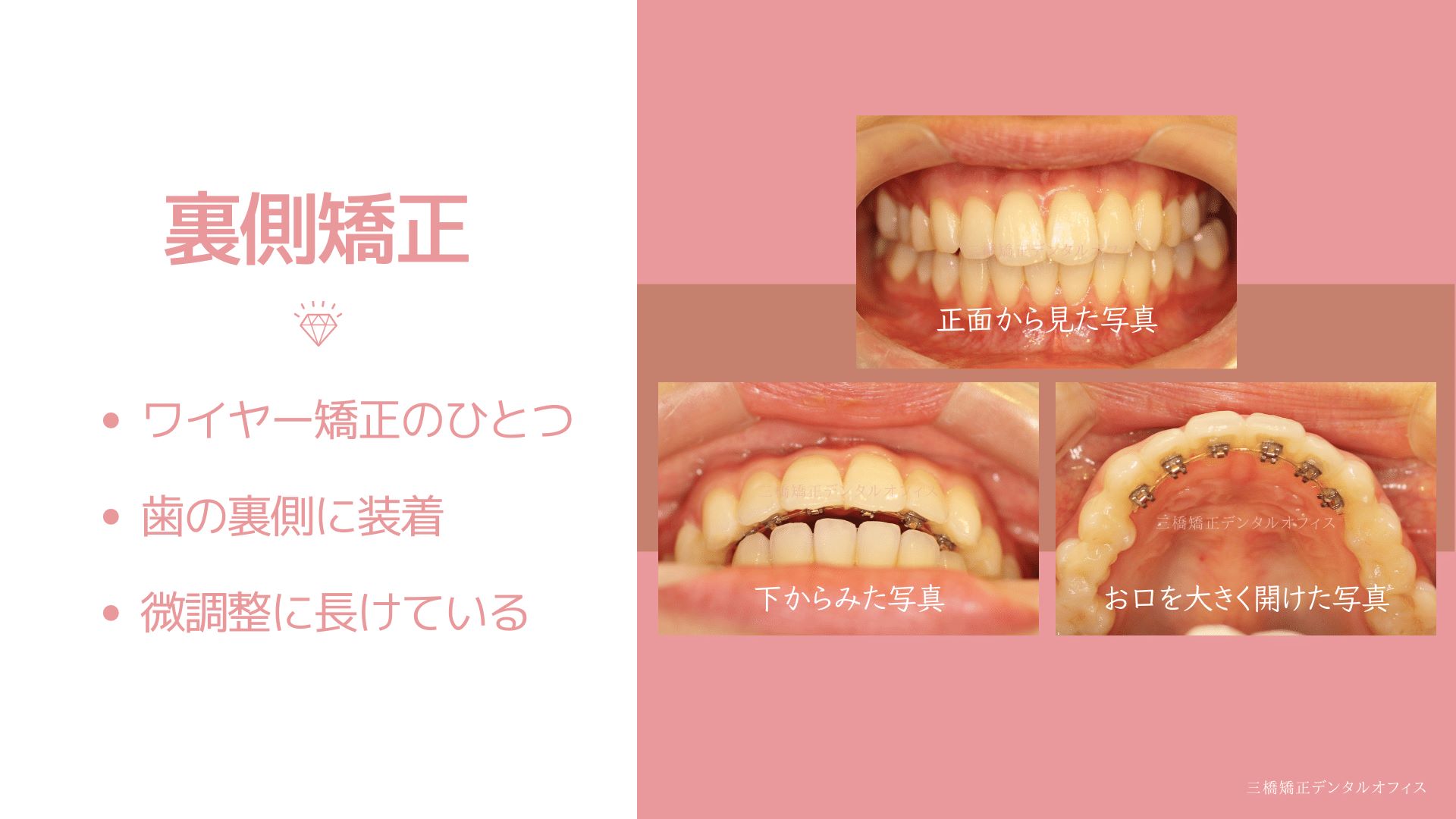 裏型矯正