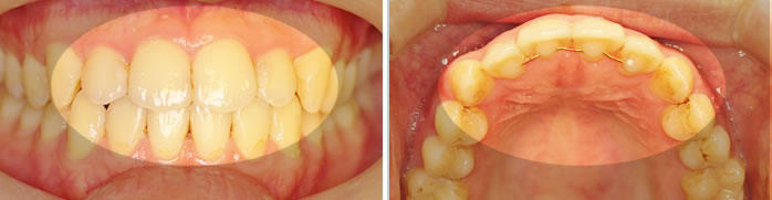上前歯4本を裏側矯正