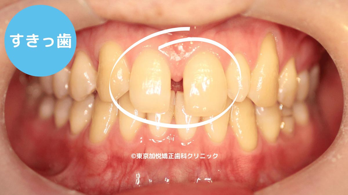 一般的なすきっ歯