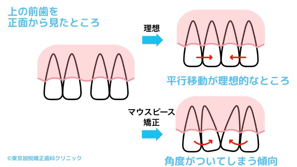 理想は並行移動。マウスピース矯正は角度がついてしまう傾向がある