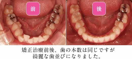 歯列全体を横方向・前方向に拡げ、全体のスペースを確保