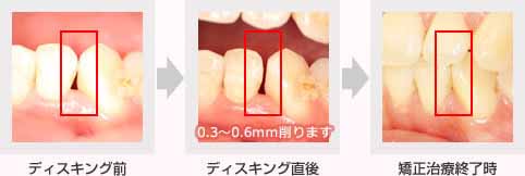 健康な歯質を削る