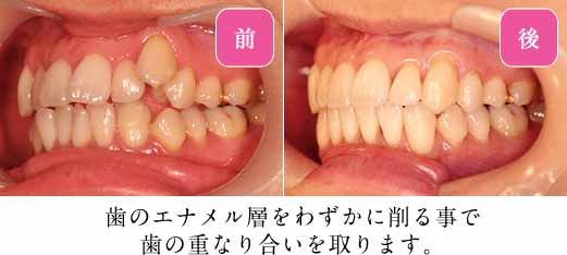 歯の側面を削り、スペースを確保