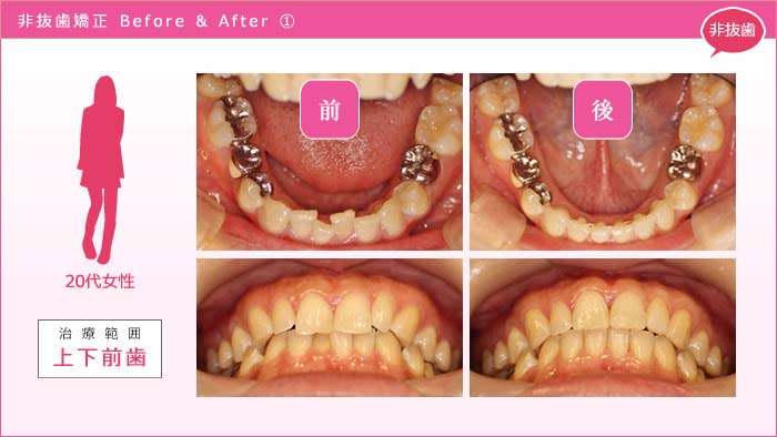 歯を抜かない矯正 事例1