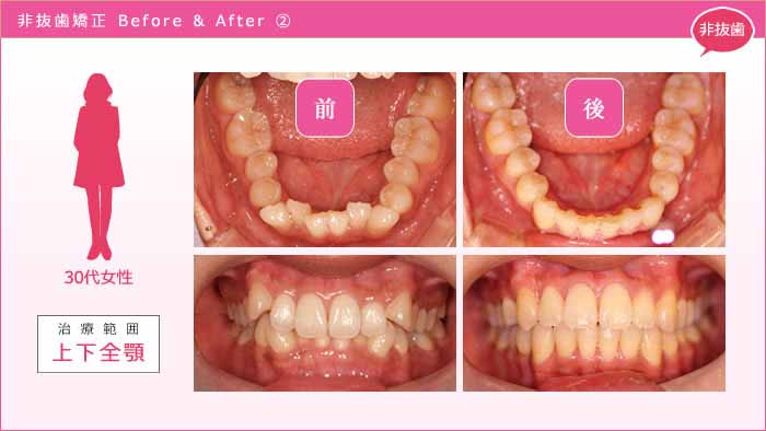 歯を抜かない矯正 事例2