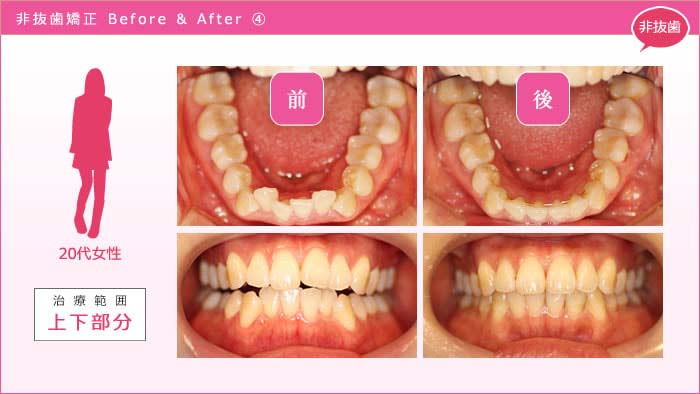 歯を抜かない矯正 事例4