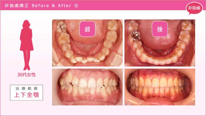 歯を抜かない矯正 事例5