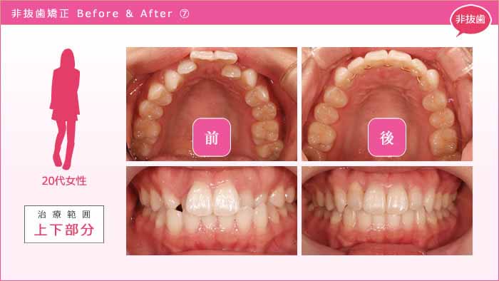 歯を抜かない矯正 事例7