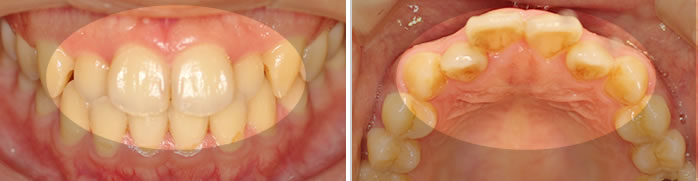 上前歯4本を裏側矯正