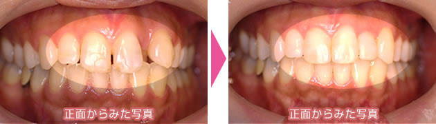 非抜歯で治療した部分矯正