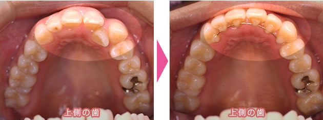 非抜歯で治療した部分矯正