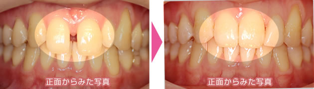 前歯のすきっ歯