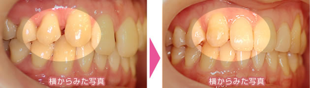 前歯のすきっ歯