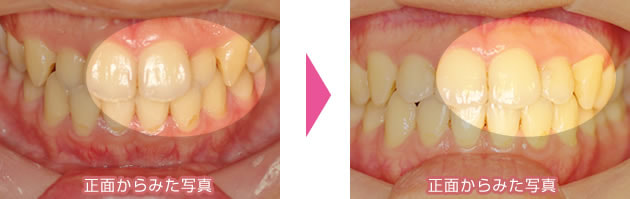 上前歯の裏側・部分矯正