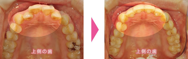 上前歯の裏側・部分矯正