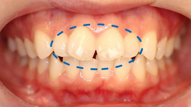 上の前歯4本の写真