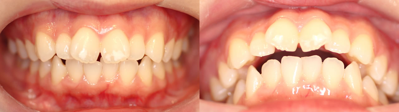 前歯2本の前突を治したい