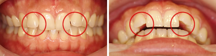 前歯の切端のバランスをとりたい
