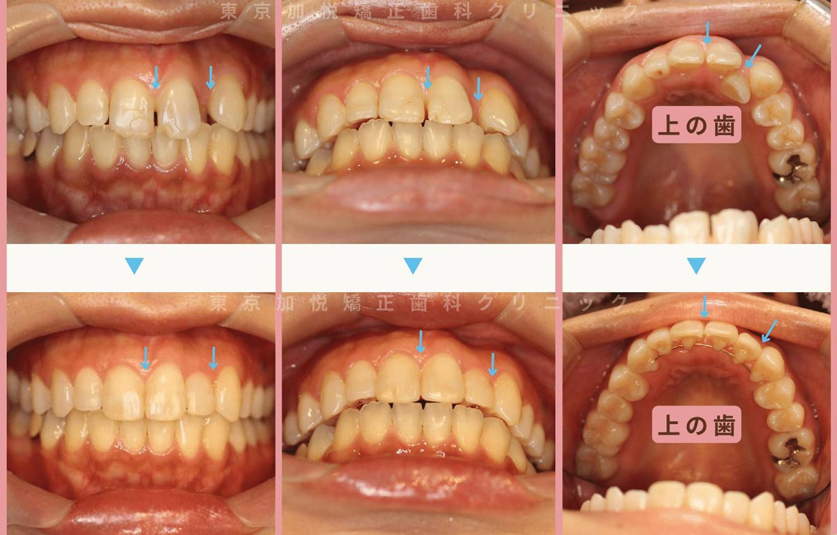 すきっ歯矯正症例１-すきっ歯を裏側矯正で治療した20代女性の写真