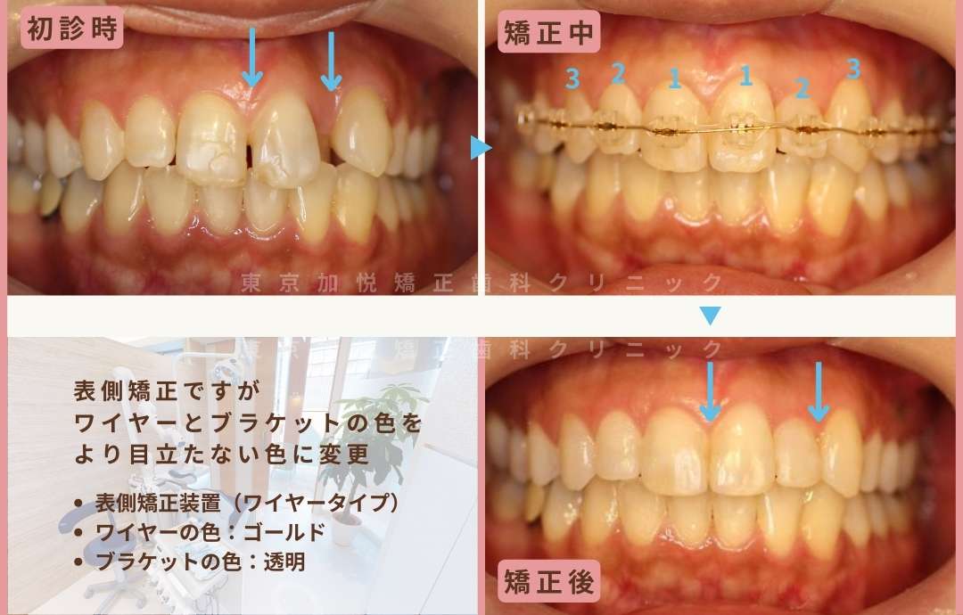 表側矯正ですが、ワイヤーとブラケットの色をより目立たない色に変更。ワイヤーの色、ゴールド。ブラケットの色、透明。