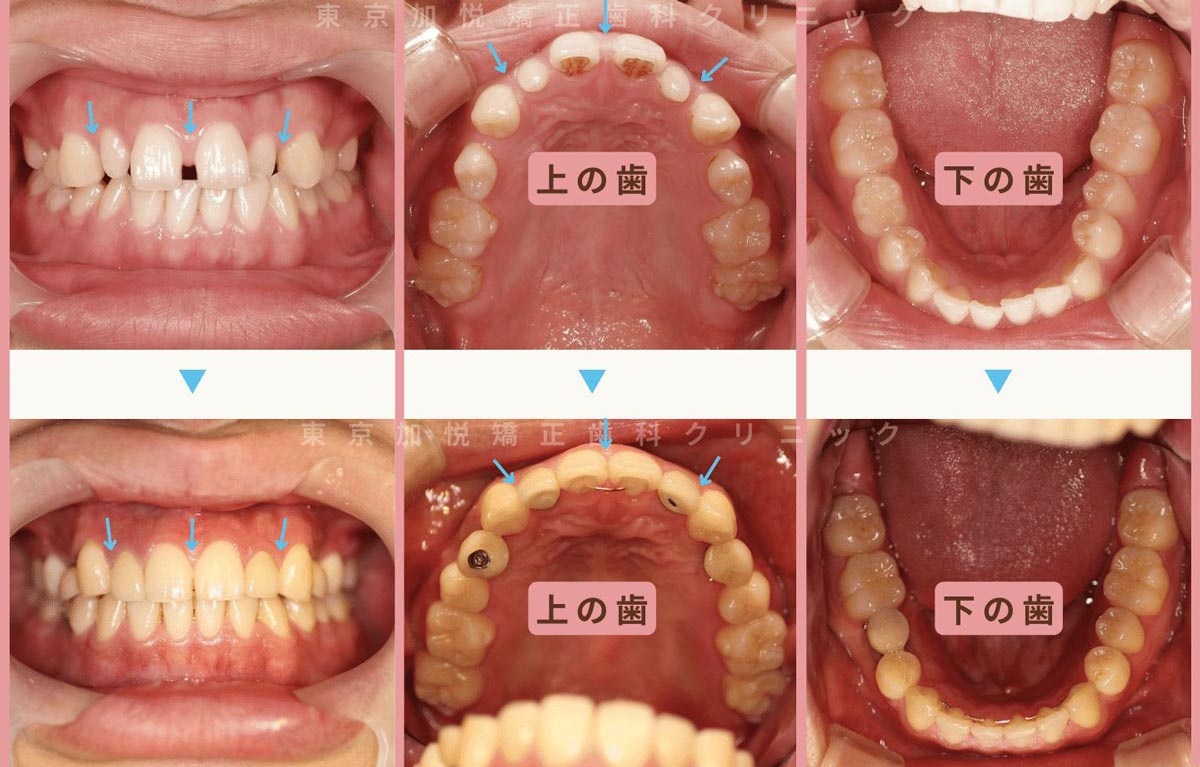 すきっ歯矯正症例2-すきっ歯を全顎矯正と補綴で治療した20代男性の写真