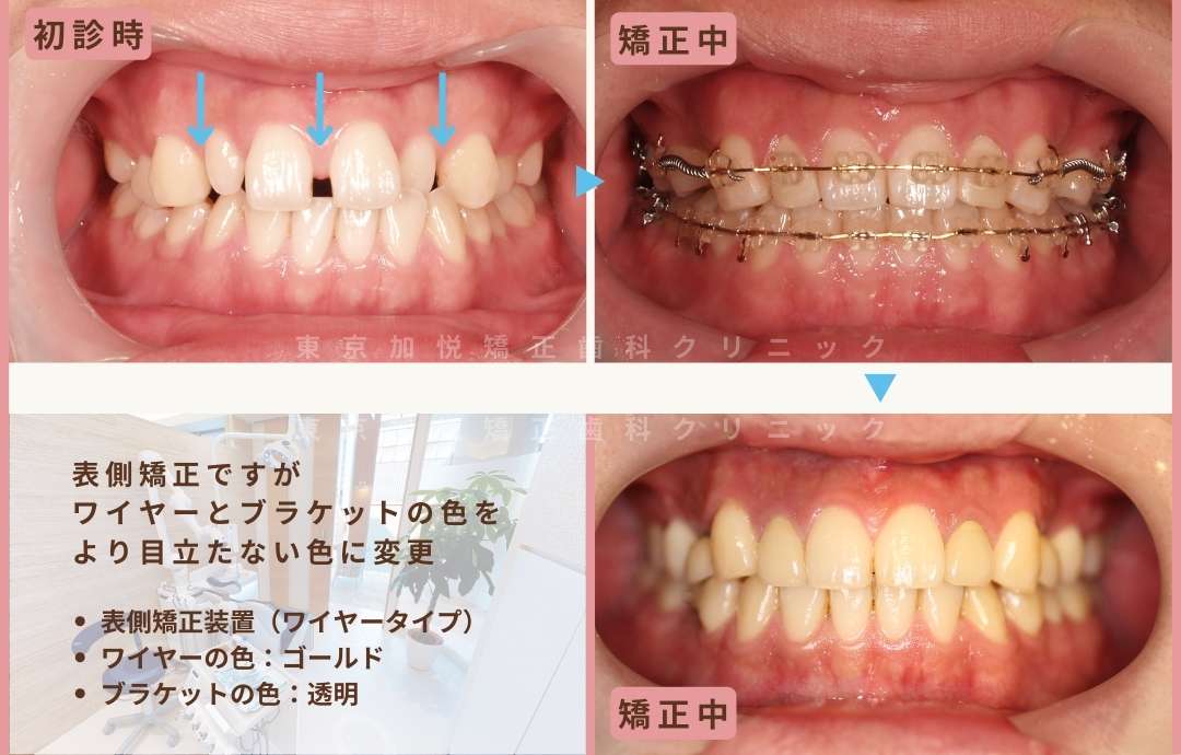 表側矯正ですが、ワイヤーとブラケットの色をより目立たない色に変更。ワイヤーの色、ゴールド。ブラケットの色、透明。