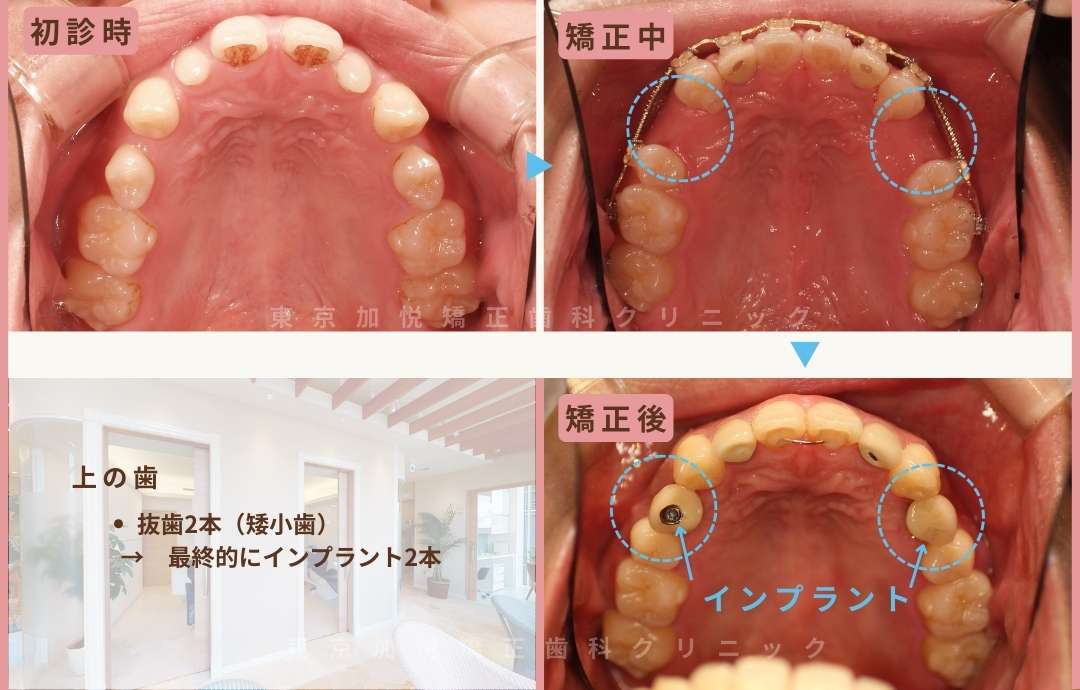 初診時、治療中、治療後の写真。上の歯抜歯2本。最終的にはインプラント2本。