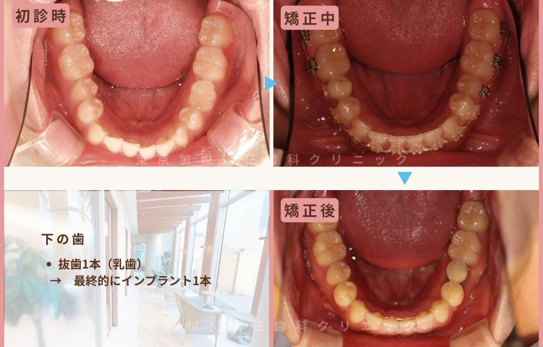 初診時、治療中、治療後の写真。下の歯抜歯1本。最終的にはインプラント1本。