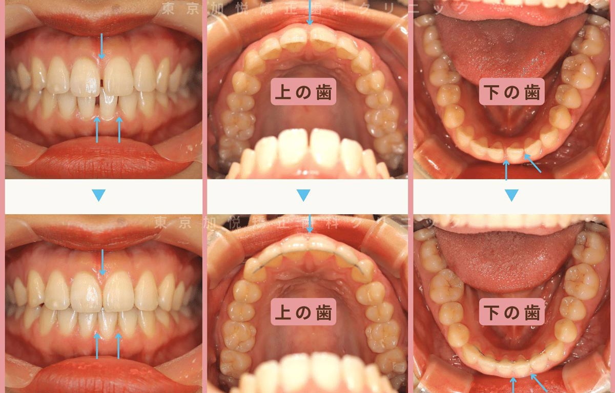 すきっ歯矯正症例3-すきっ歯を部分矯正で治療した20才女性の写真