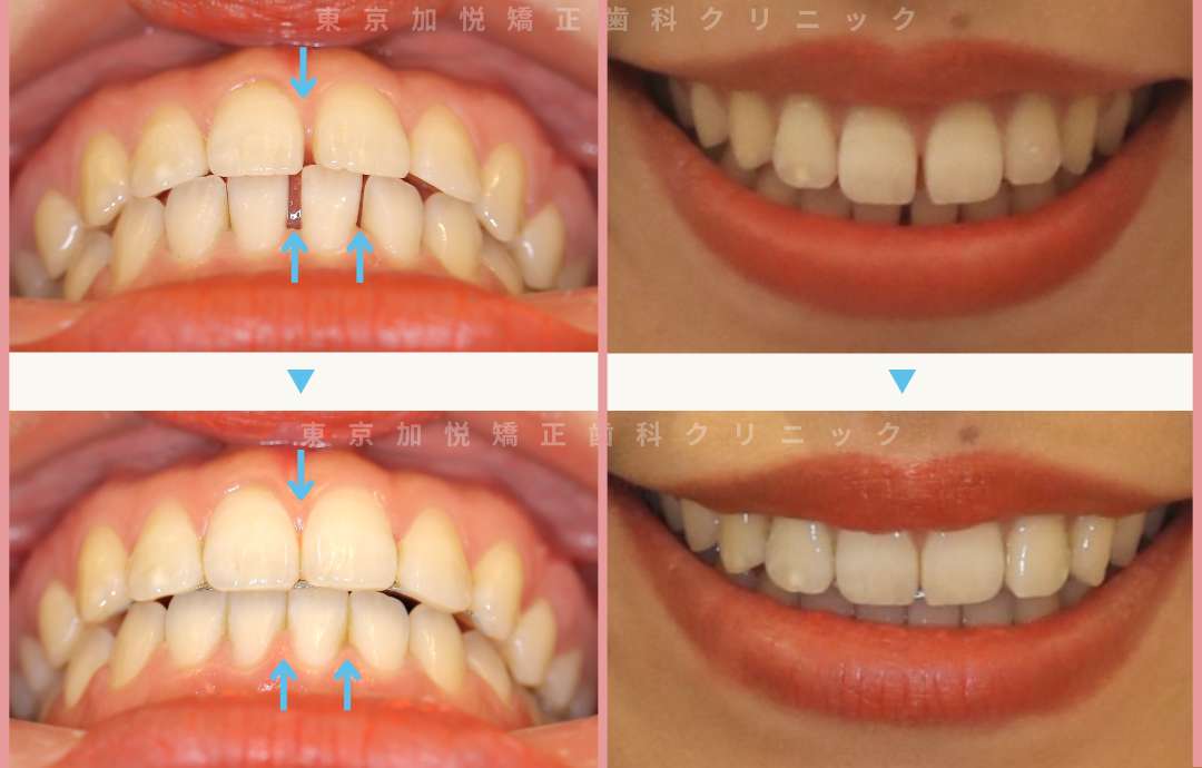 すきっ歯矯正症例3-すきっ歯を部分矯正で治療した20才女性の写真。正面、下から、口元の3方向から。