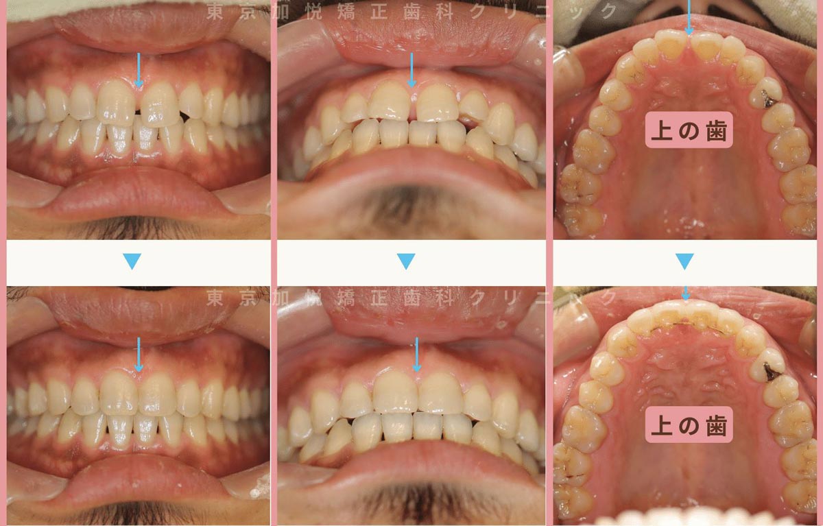 すきっ歯矯正症例4-すきっ歯を前歯の裏側矯正で治療した30代男性の写真