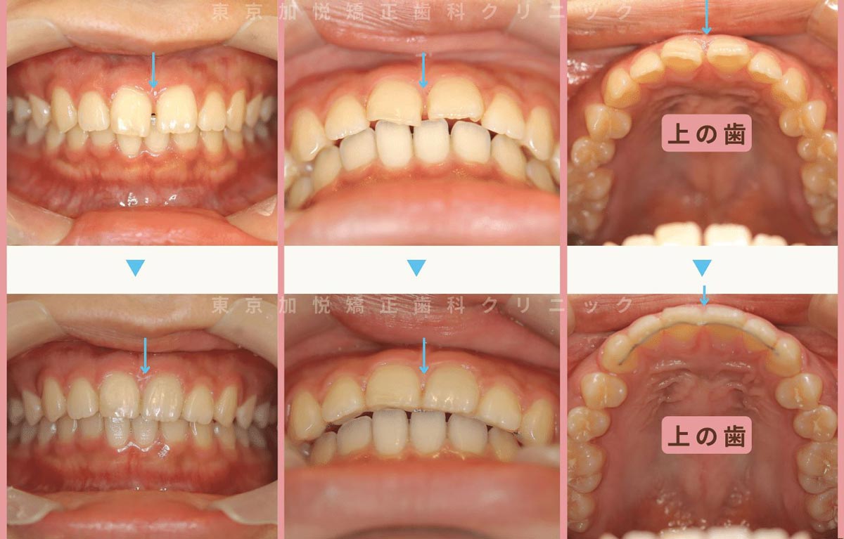 すきっ歯矯正症例5-すきっ歯を裏側矯正で治療した20代女性の写真