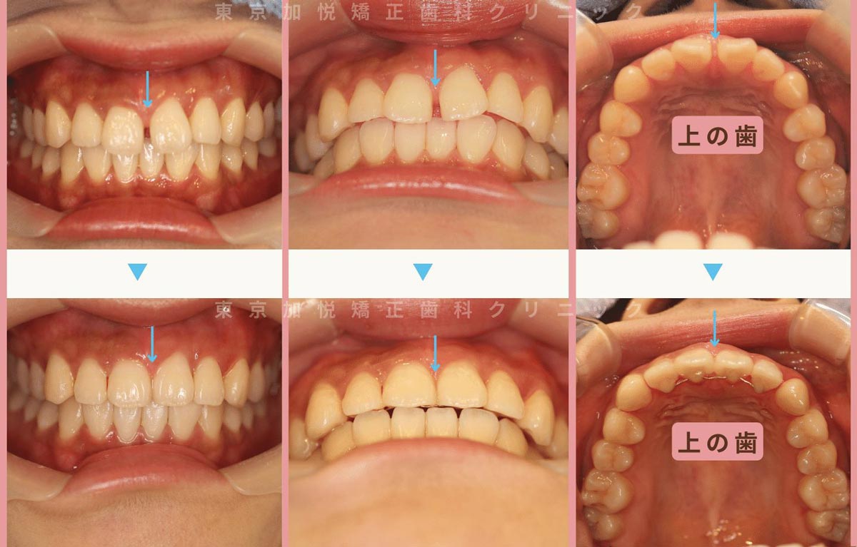 すきっ歯矯正症例6-すきっ歯を表側矯正で治療した23才女性の写真