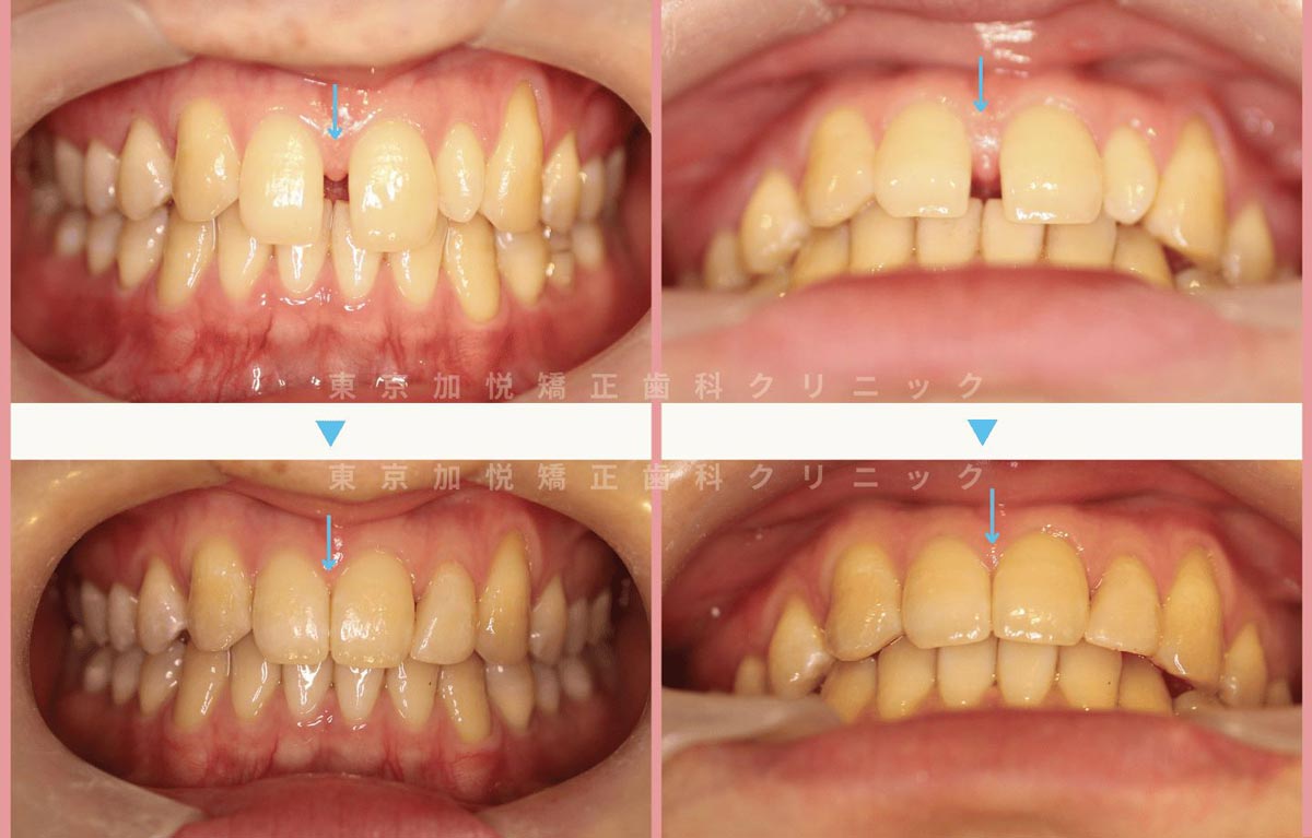 すきっ歯矯正症例7-すきっ歯と矮小歯・欠損歯を矯正と補綴で治療した20代女性の写真